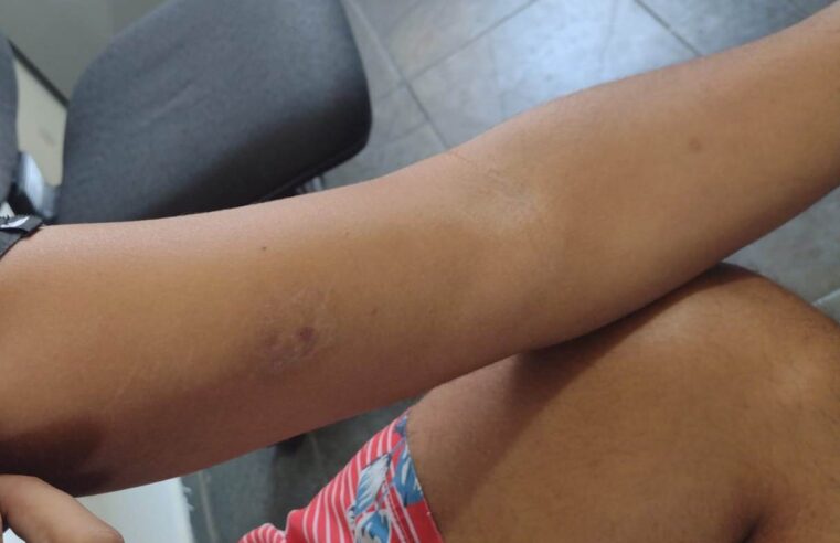 MULHER ESCAPA DE AGRESSÃO MORDENDO HOMEM
