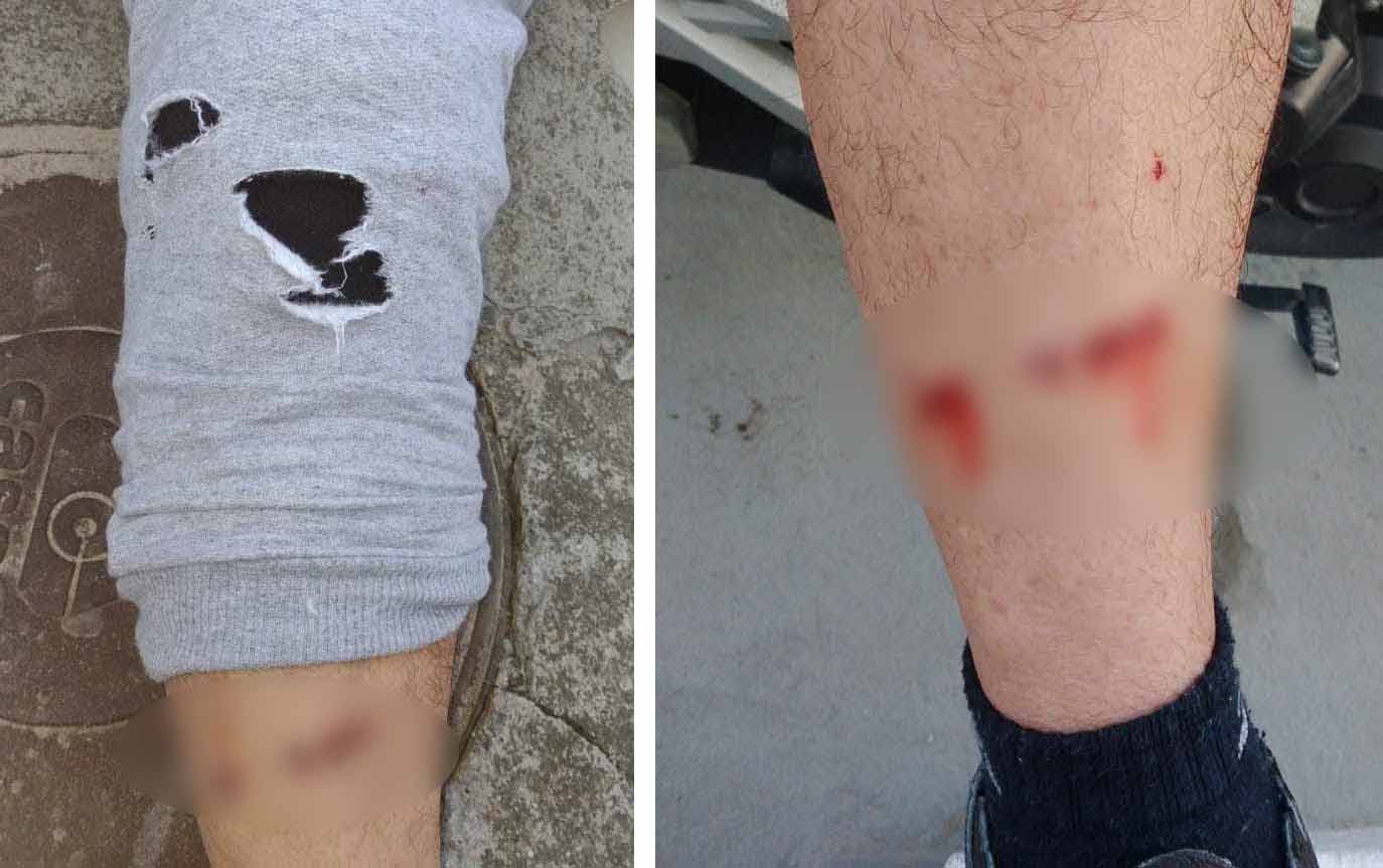 MORDIDO POR CÃO, HOMEM BUSCA JUSTIÇA E COBRA MAIS FISCALIZAÇÃO