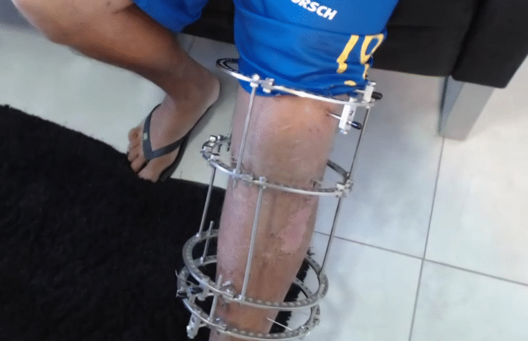 POLÍCIA CIVIL APREENDE VEÍCULO E INDICIA CONDUTOR ENVOLVIDO EM ATROPELAMENTO COM FUGA( VÍDEO)